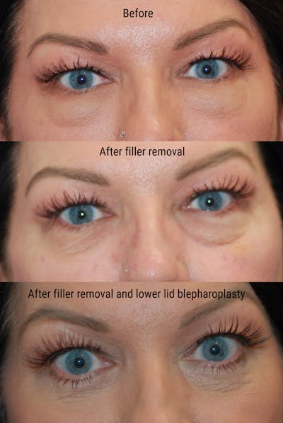 Eyelid Surgery Before & After Gallery - Patient 402947 - Image 2
