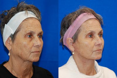 Facelift Before & After Gallery - Patient 103465 - Image 1