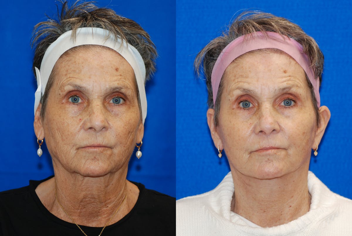 Facelift Before & After Gallery - Patient 103465 - Image 3