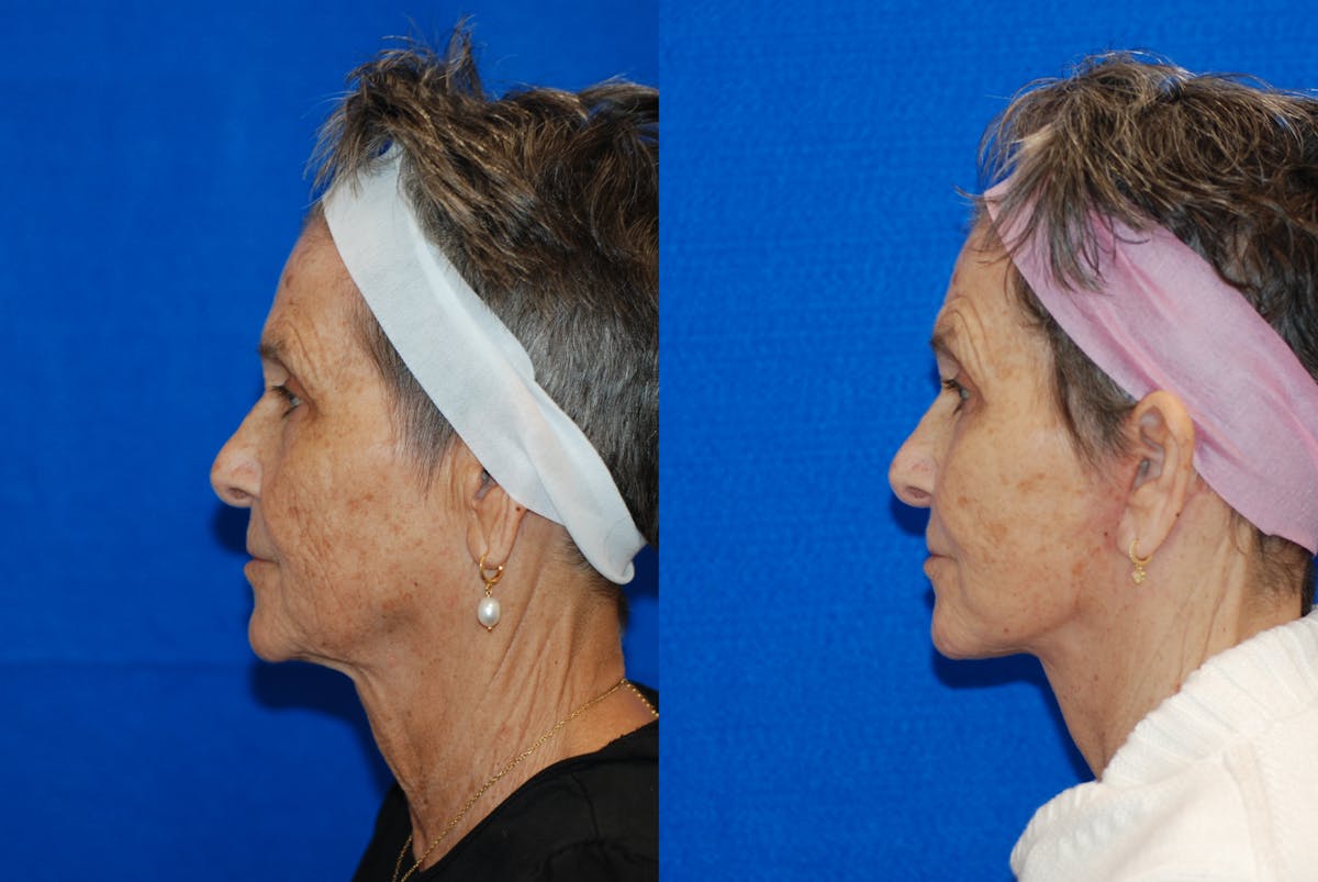 Facelift Before & After Gallery - Patient 103465 - Image 5