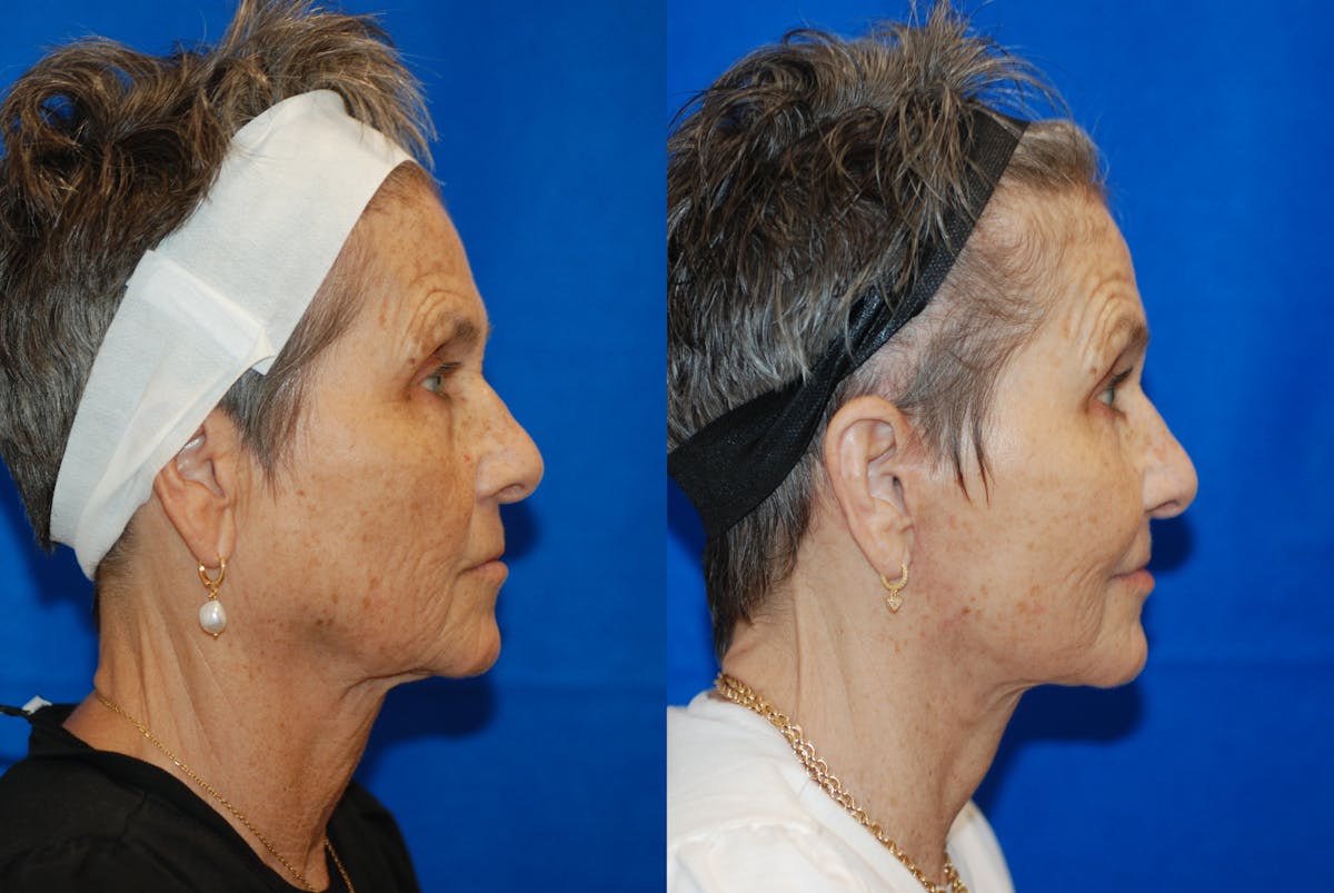 Facelift Before & After Gallery - Patient 103465 - Image 3