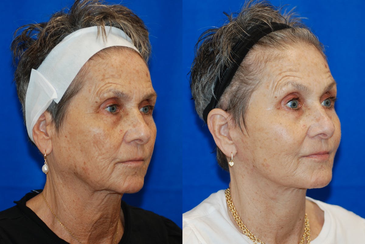 Facelift Before & After Gallery - Patient 103465 - Image 1