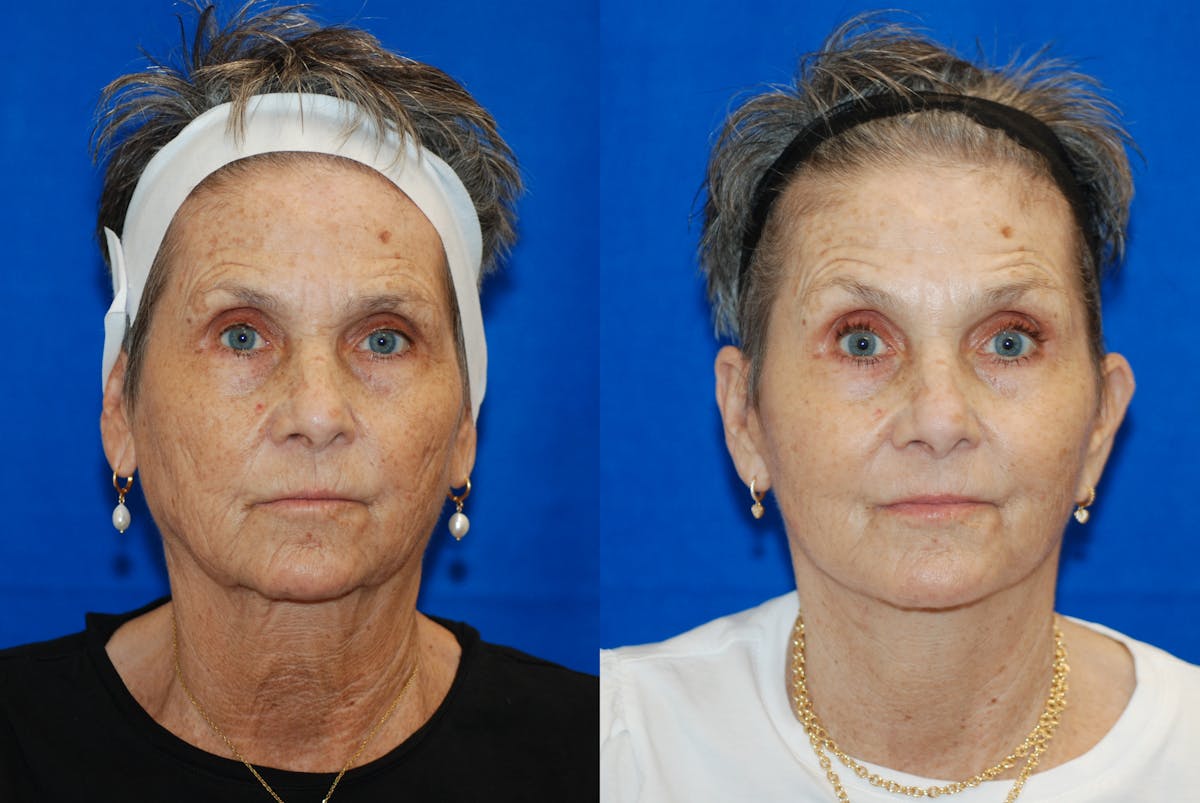 Facelift Before & After Gallery - Patient 103465 - Image 2