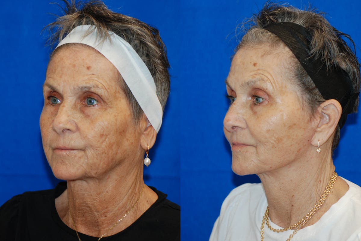 Facelift Before & After Gallery - Patient 103465 - Image 4