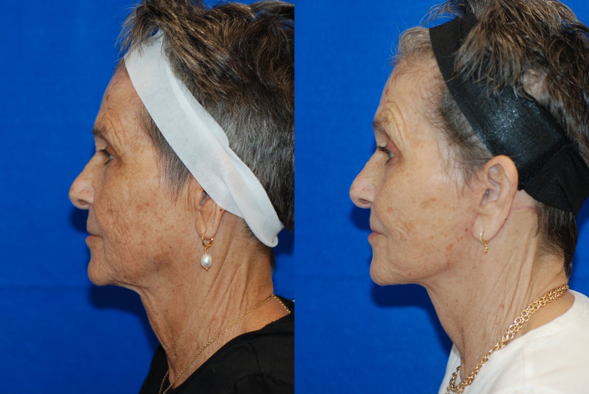 Facelift Before & After Gallery - Patient 103465 - Image 5