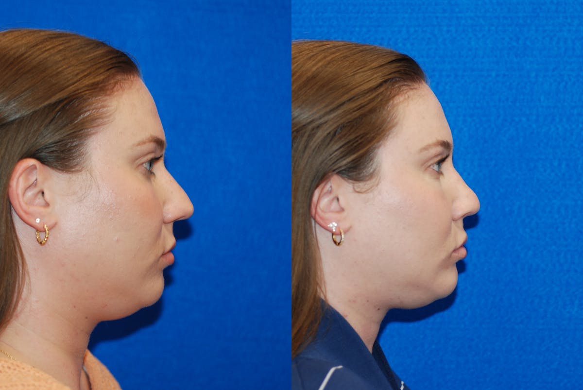 Rhinoplasty Before & After Gallery - Patient 771796 - Image 1