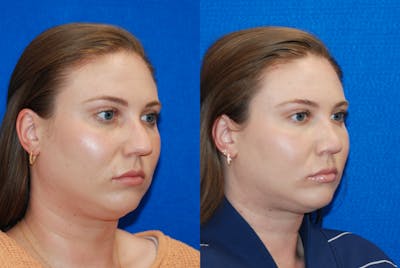 Rhinoplasty Before & After Gallery - Patient 771796 - Image 1