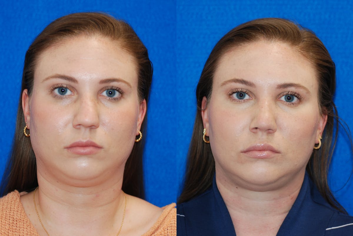 Rhinoplasty Before & After Gallery - Patient 771796 - Image 3