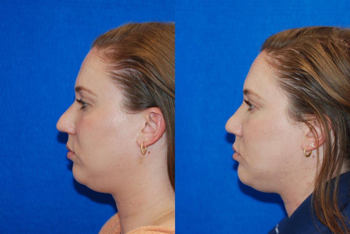 Rhinoplasty Before & After Gallery - Patient 771796 - Image 5