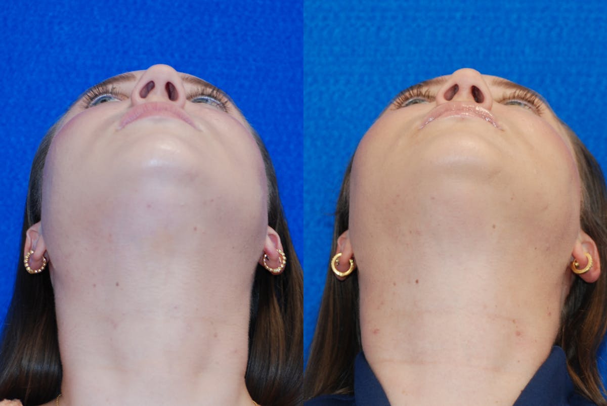 Rhinoplasty Before & After Gallery - Patient 771796 - Image 6