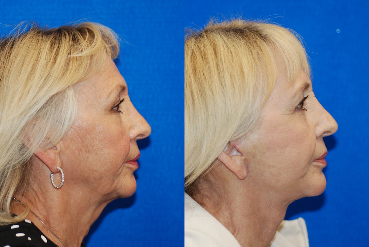 Facelift Before & After Gallery - Patient 317745 - Image 3
