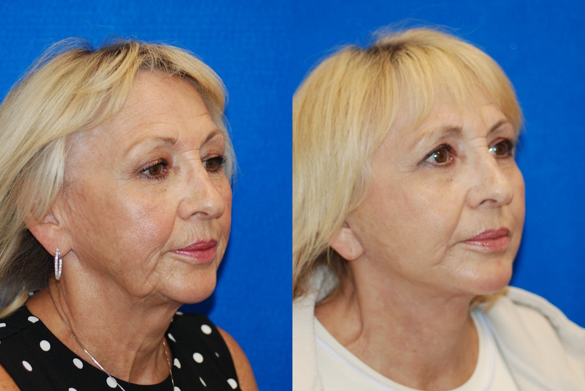 Facelift Before & After Gallery - Patient 317745 - Image 1