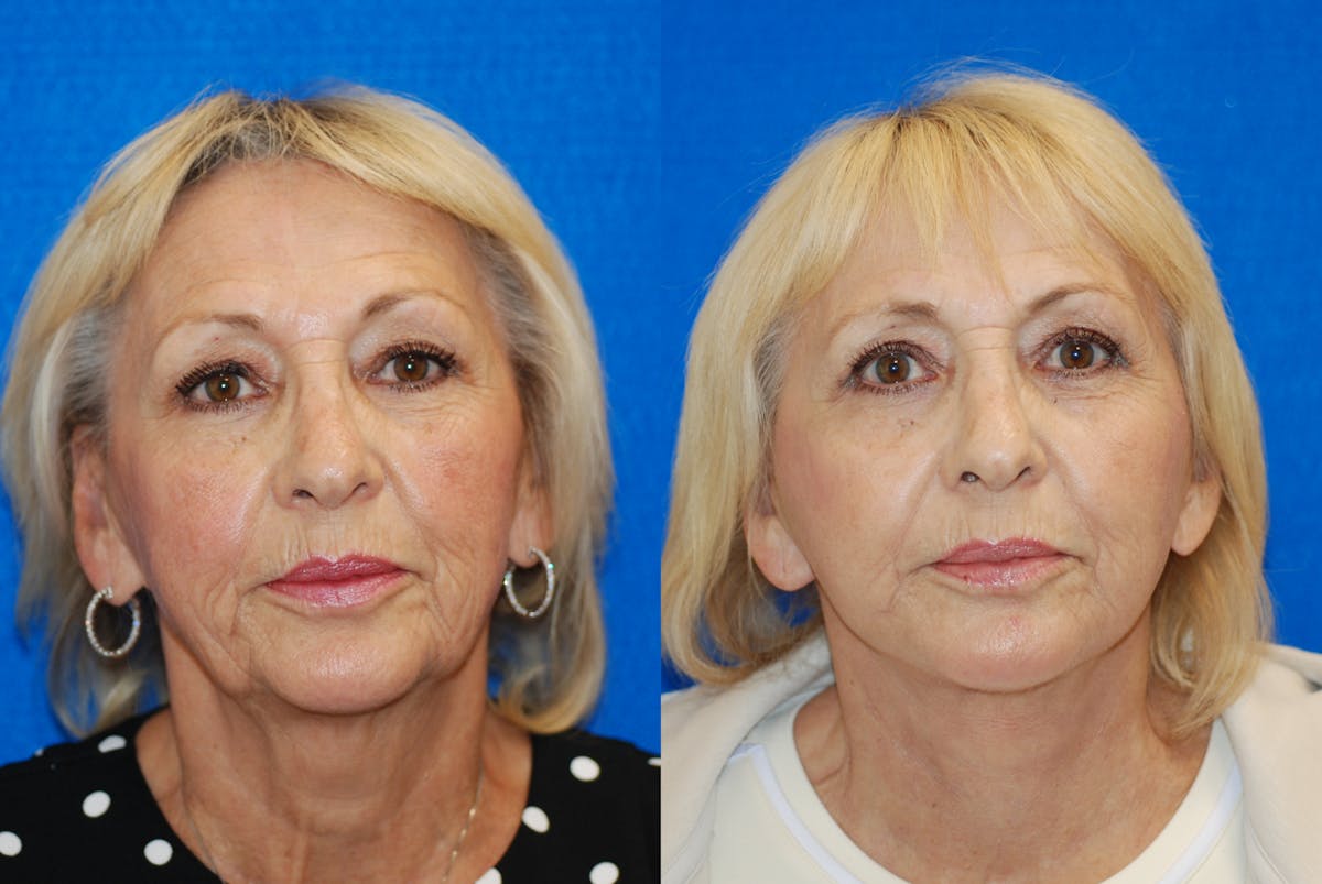 Facelift Before & After Gallery - Patient 317745 - Image 2