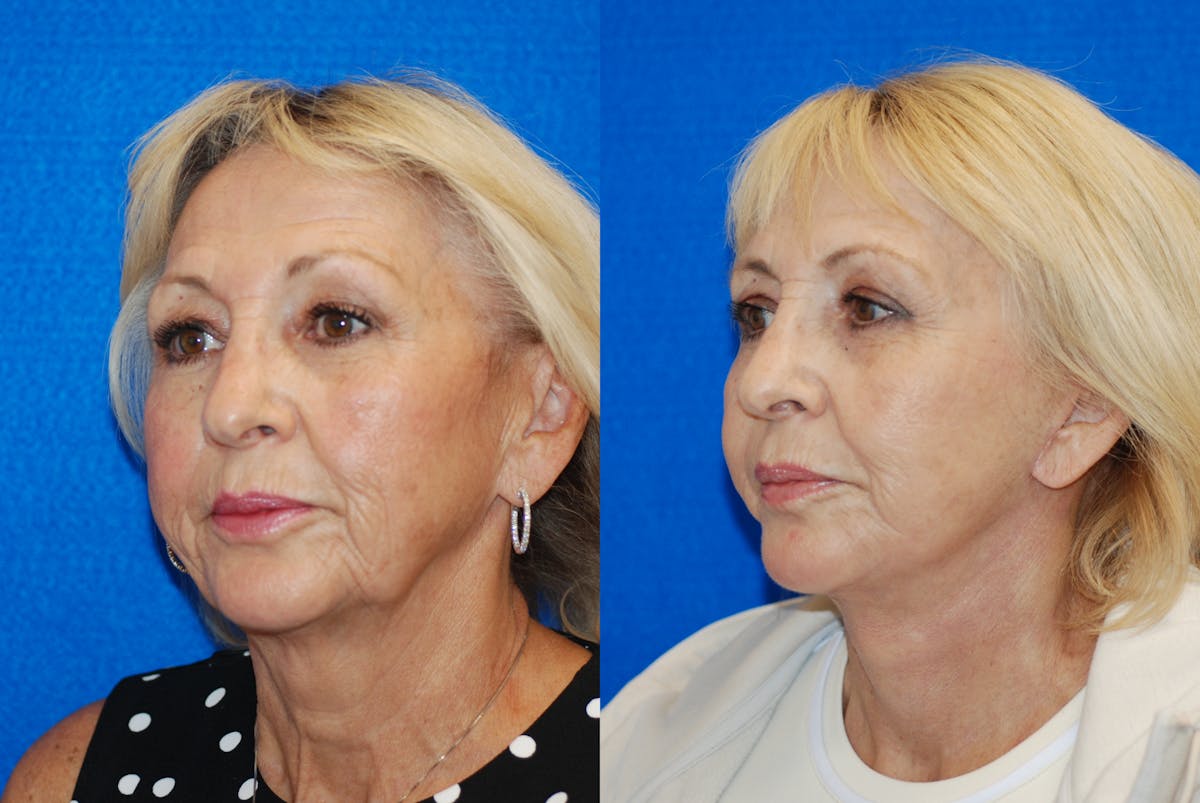 Facelift Before & After Gallery - Patient 317745 - Image 4