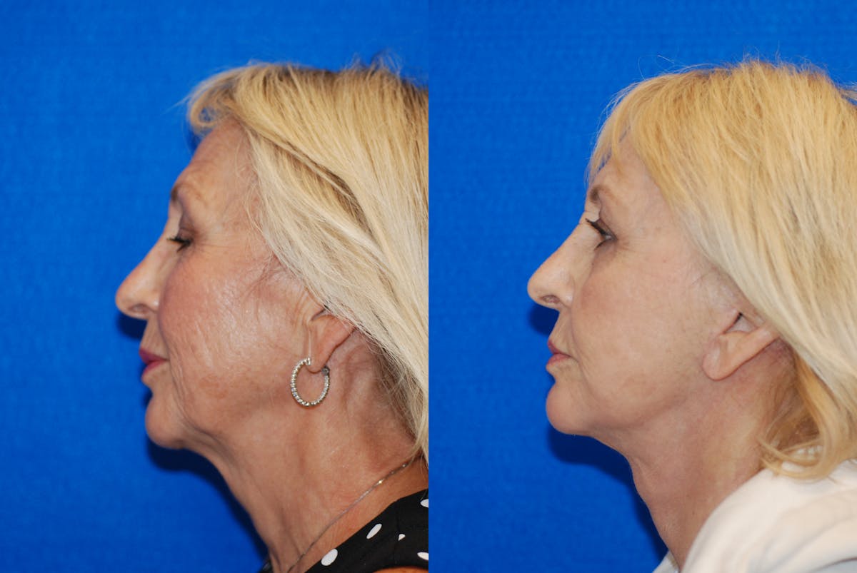 Facelift Before & After Gallery - Patient 317745 - Image 5