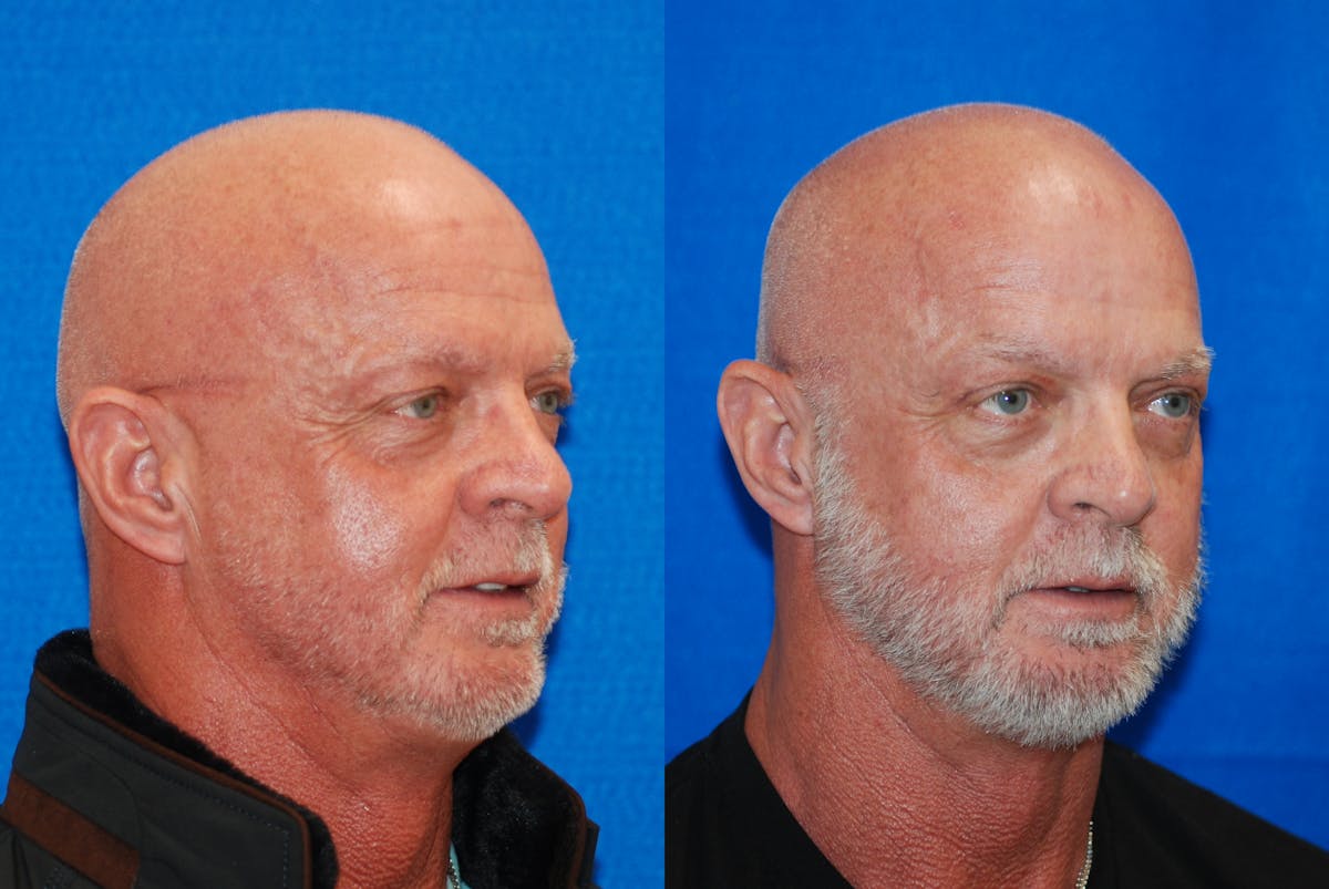 Eyelid Surgery Before & After Gallery - Patient 219450 - Image 2