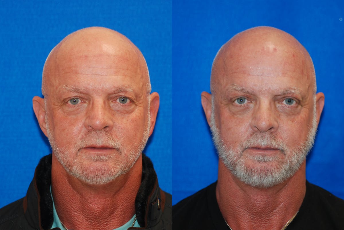 Eyelid Surgery Before & After Gallery - Patient 219450 - Image 1