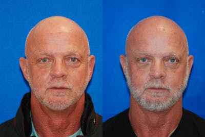 Eyelid Surgery Before & After Gallery - Patient 219450 - Image 1