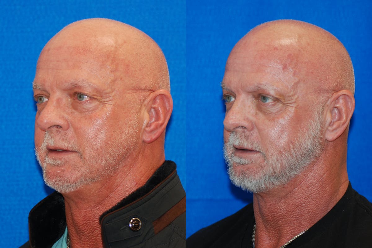 Eyelid Surgery Before & After Gallery - Patient 219450 - Image 4