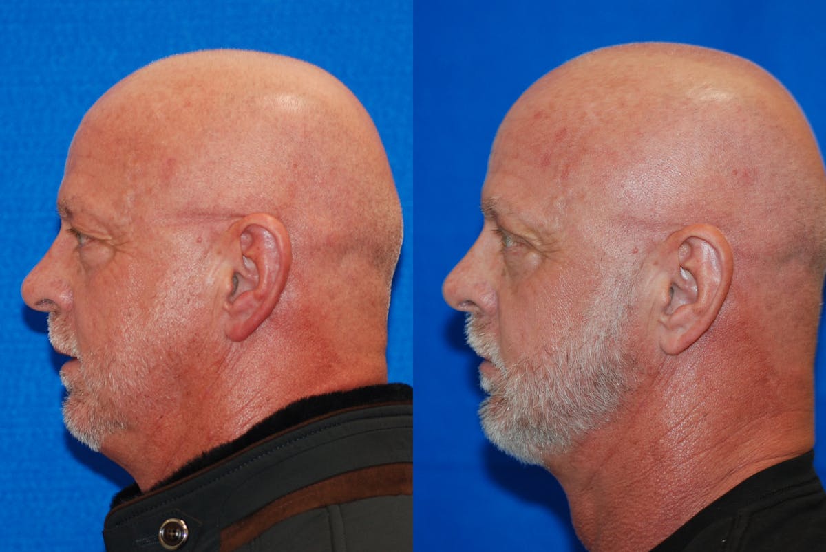 Eyelid Surgery Before & After Gallery - Patient 219450 - Image 5