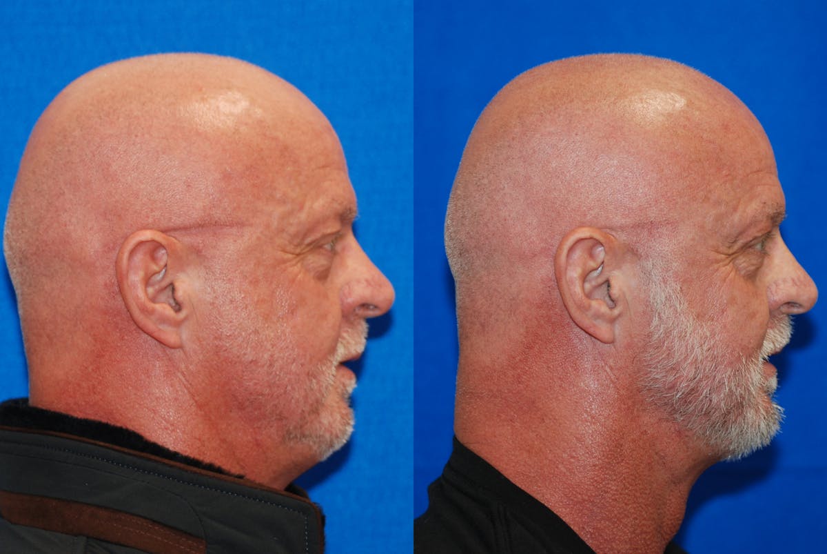 Eyelid Surgery Before & After Gallery - Patient 219450 - Image 3