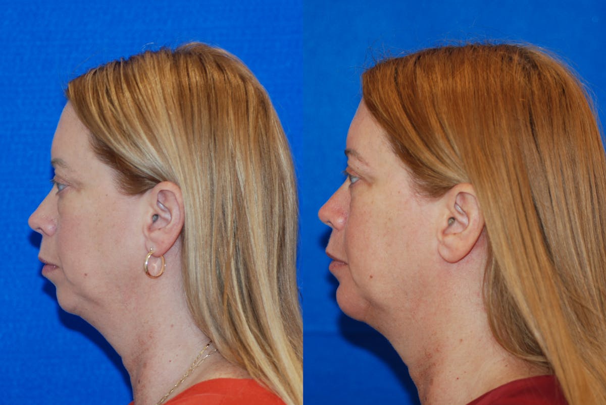 Chin Implant Before & After Gallery - Patient 377506 - Image 5