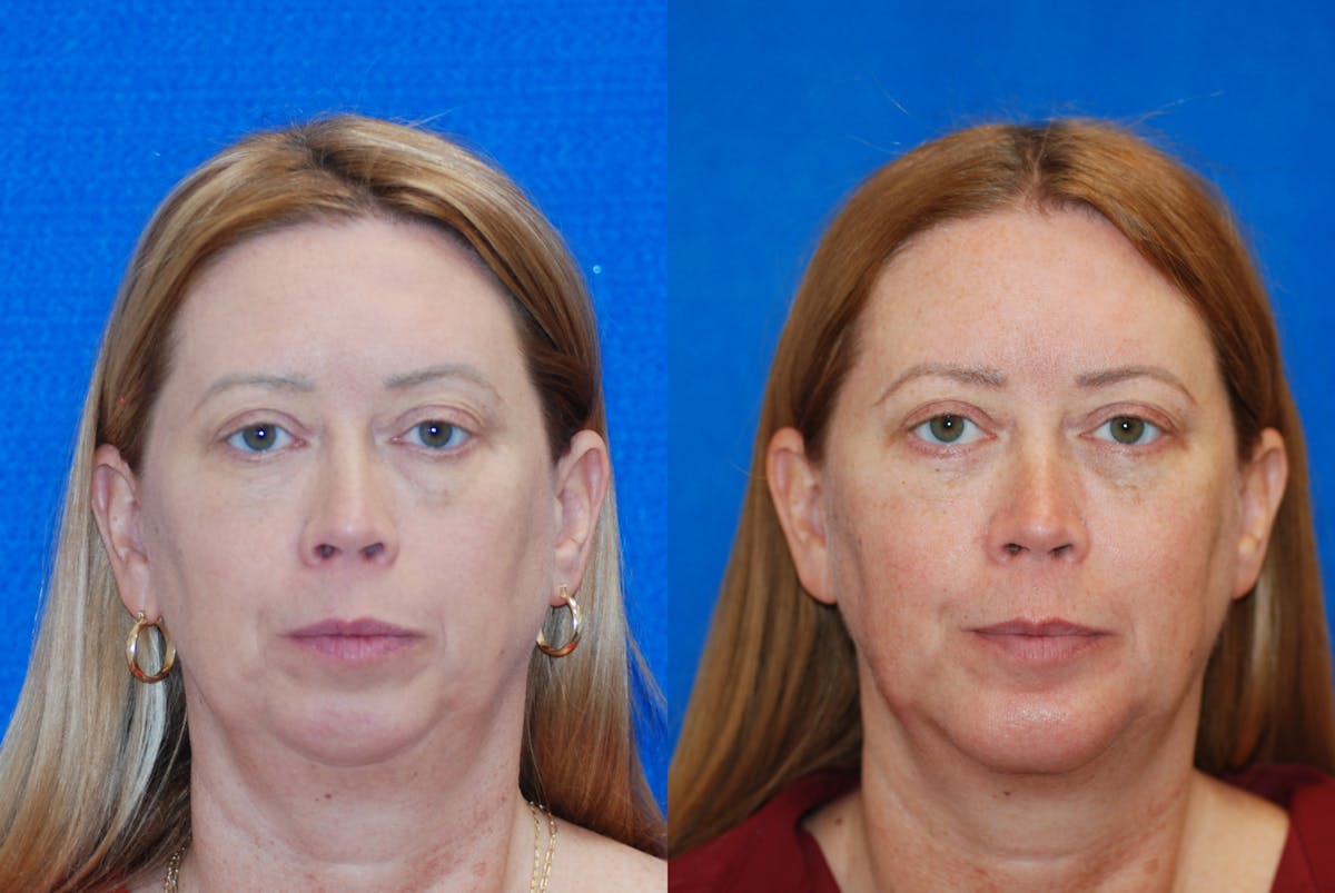 Chin Implant Before & After Gallery - Patient 377506 - Image 1