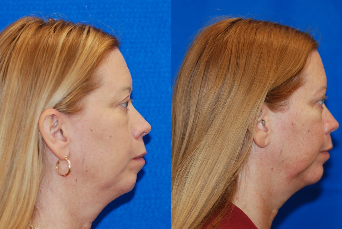 Chin Implant Before & After Gallery - Patient 377506 - Image 3