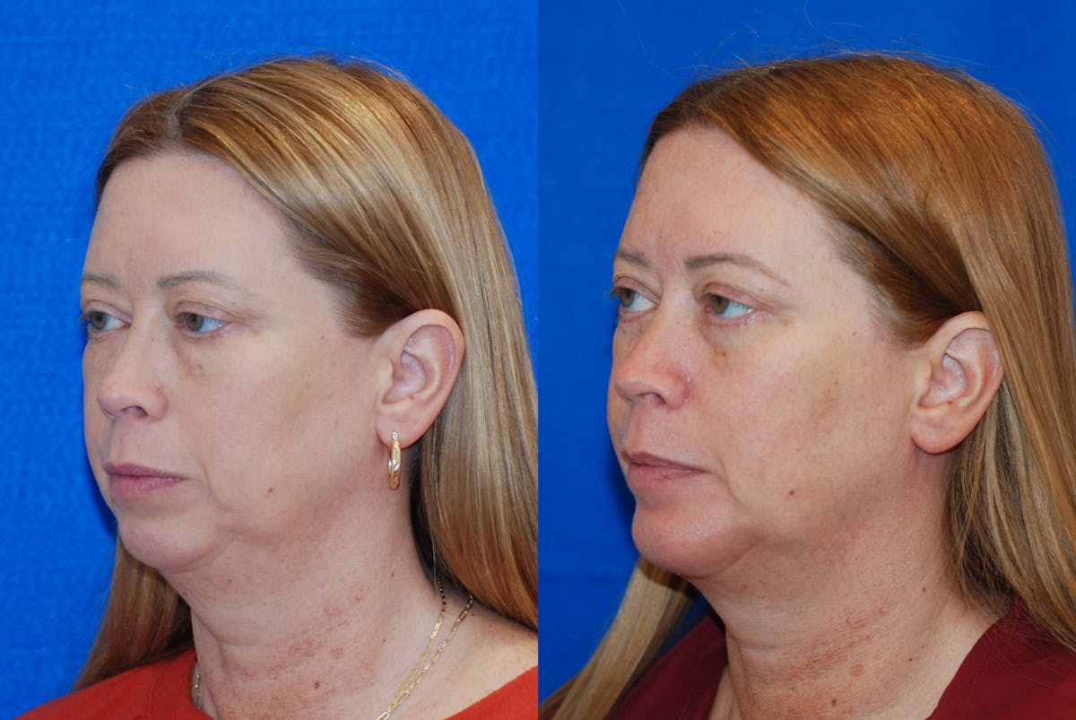 Chin Implant Before & After Gallery - Patient 377506 - Image 4
