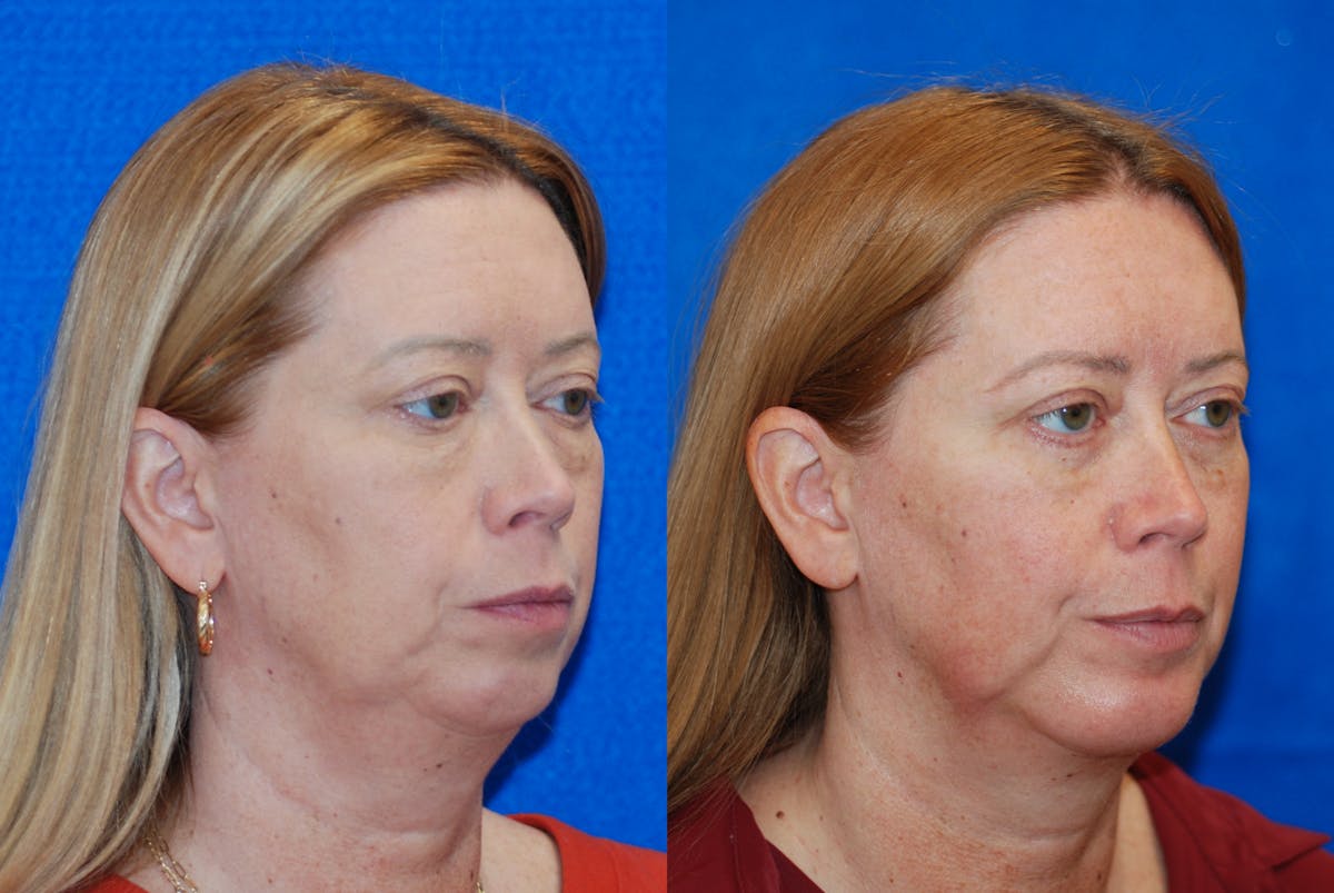 Chin Implant Before & After Gallery - Patient 377506 - Image 2