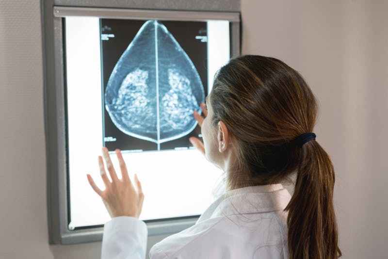 doctor inspecting breast xray after mammogram