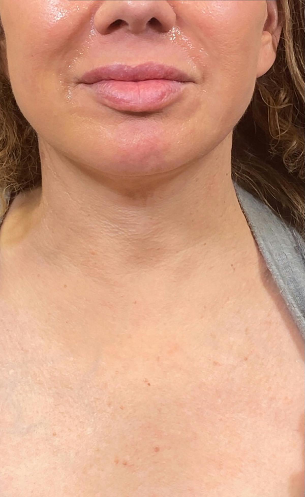 procedure