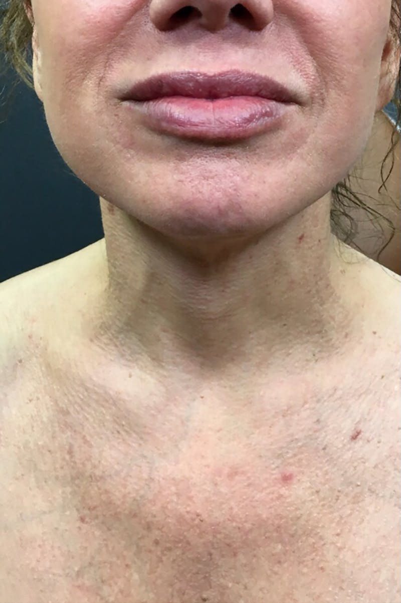 Broadband Laser (BBL) Before & After Gallery - Patient 66603998 - Image 1
