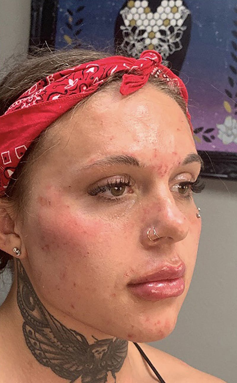 Dermal Fillers Before & After Gallery - Patient 66604035 - Image 2