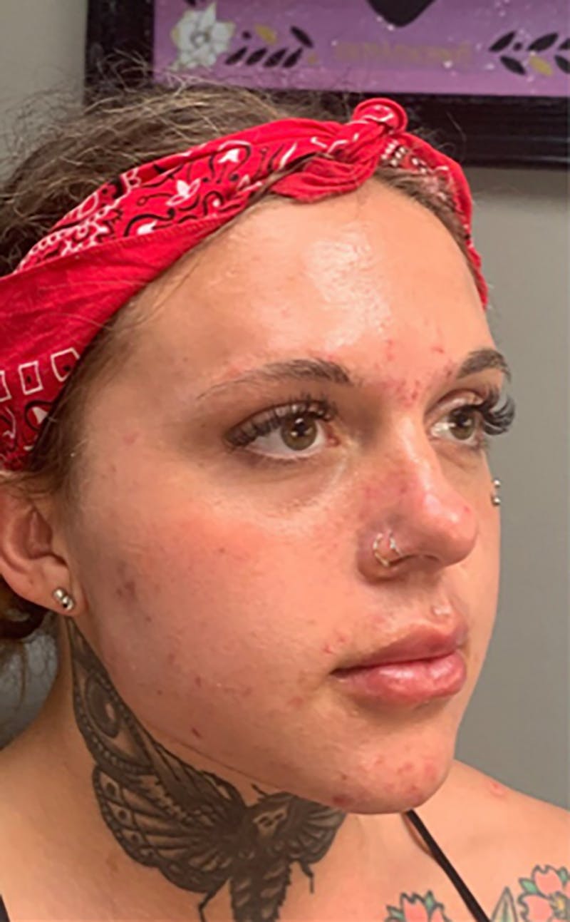 Dermal Fillers Before & After Gallery - Patient 66604035 - Image 1