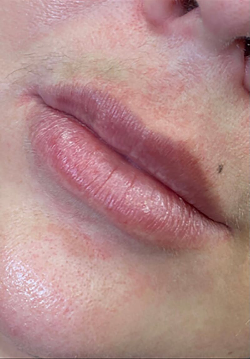 Dermal Fillers Before & After Gallery - Patient 66604036 - Image 1
