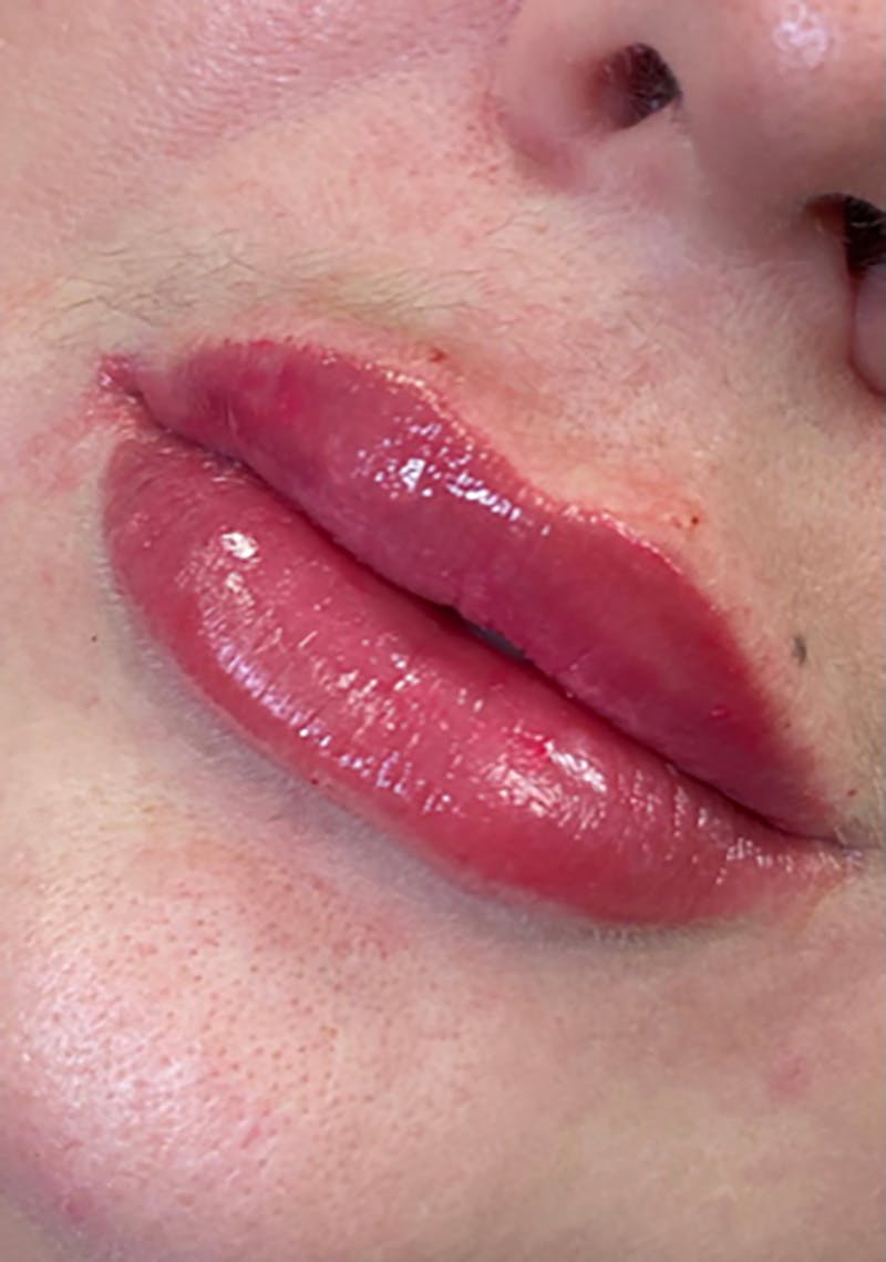 Dermal Fillers Before & After Gallery - Patient 66604036 - Image 2
