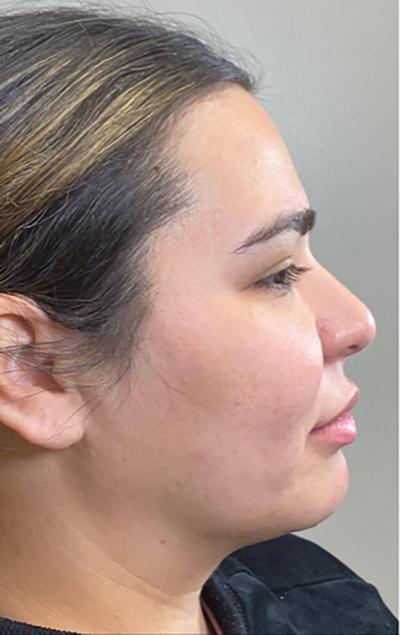Dermal Fillers Before & After Gallery - Patient 66604037 - Image 1