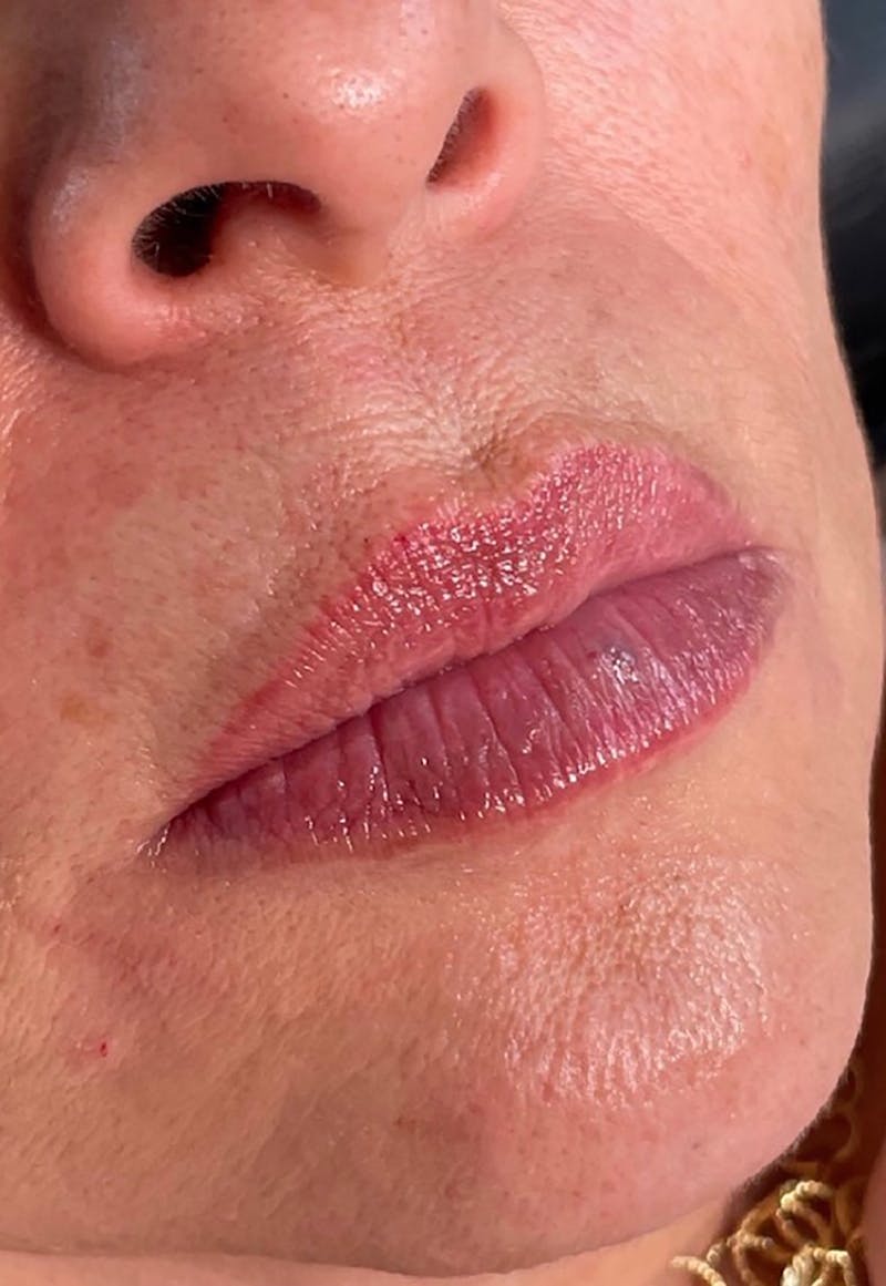 Dermal Fillers Before & After Gallery - Patient 66604038 - Image 2