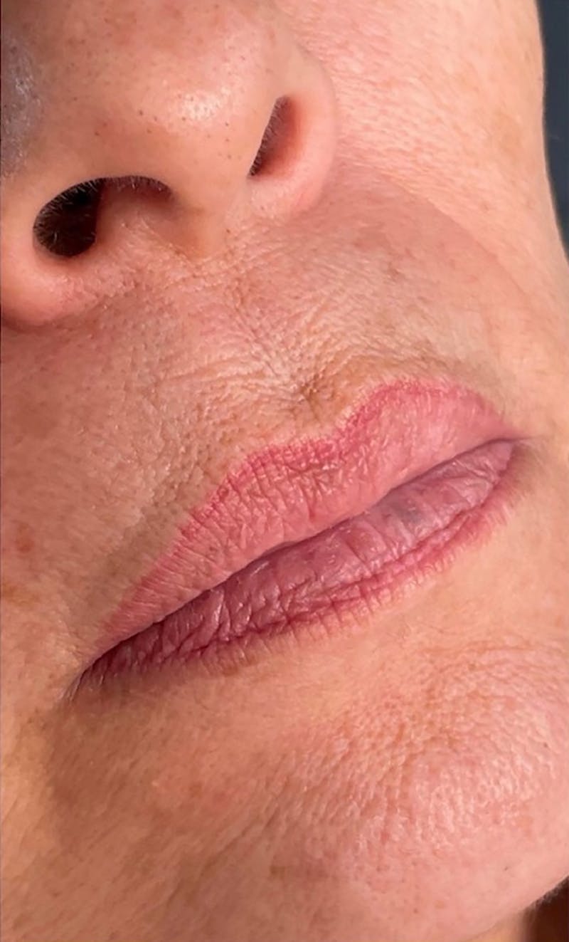 Dermal Fillers Before & After Gallery - Patient 66604038 - Image 1