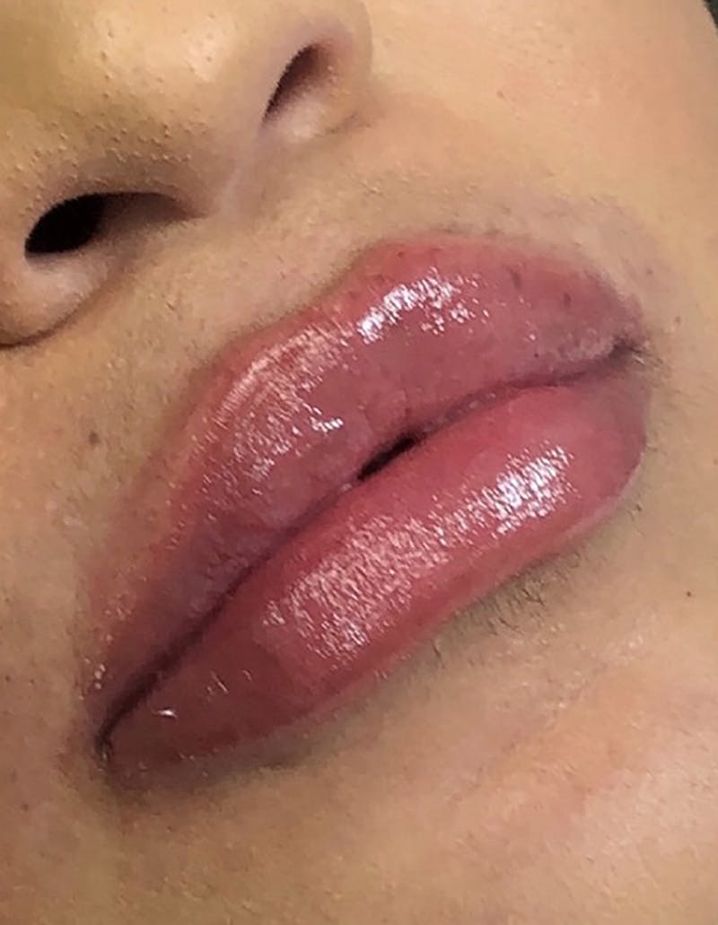 Dermal Fillers Before & After Gallery - Patient 66604039 - Image 2