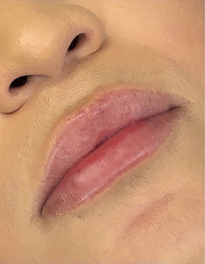 Dermal Fillers Before & After Gallery - Patient 66604039 - Image 1