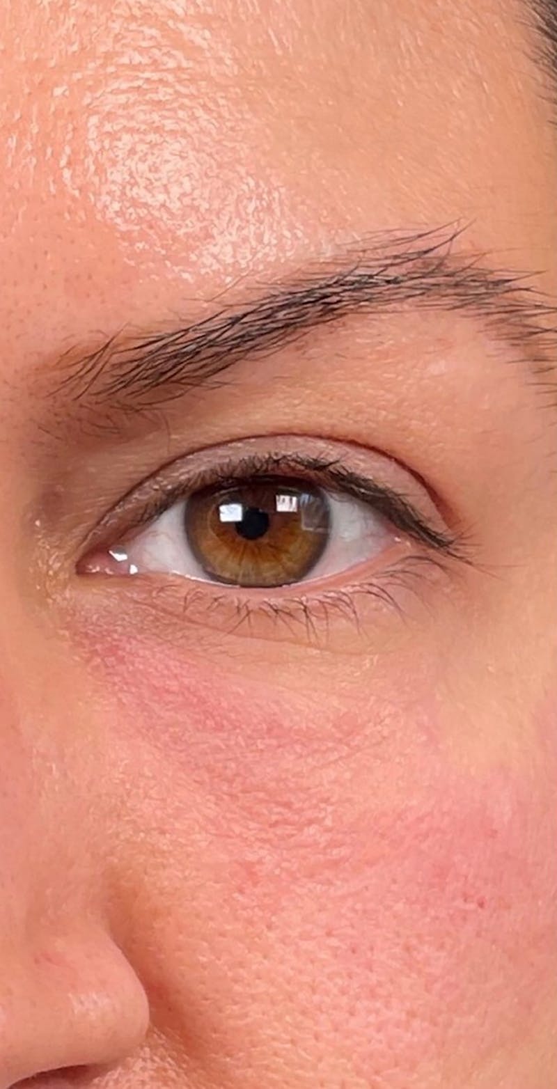 Dermal Fillers Before & After Gallery - Patient 66604040 - Image 2