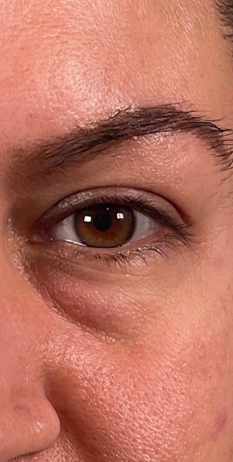 Dermal Fillers Before & After Gallery - Patient 66604040 - Image 1