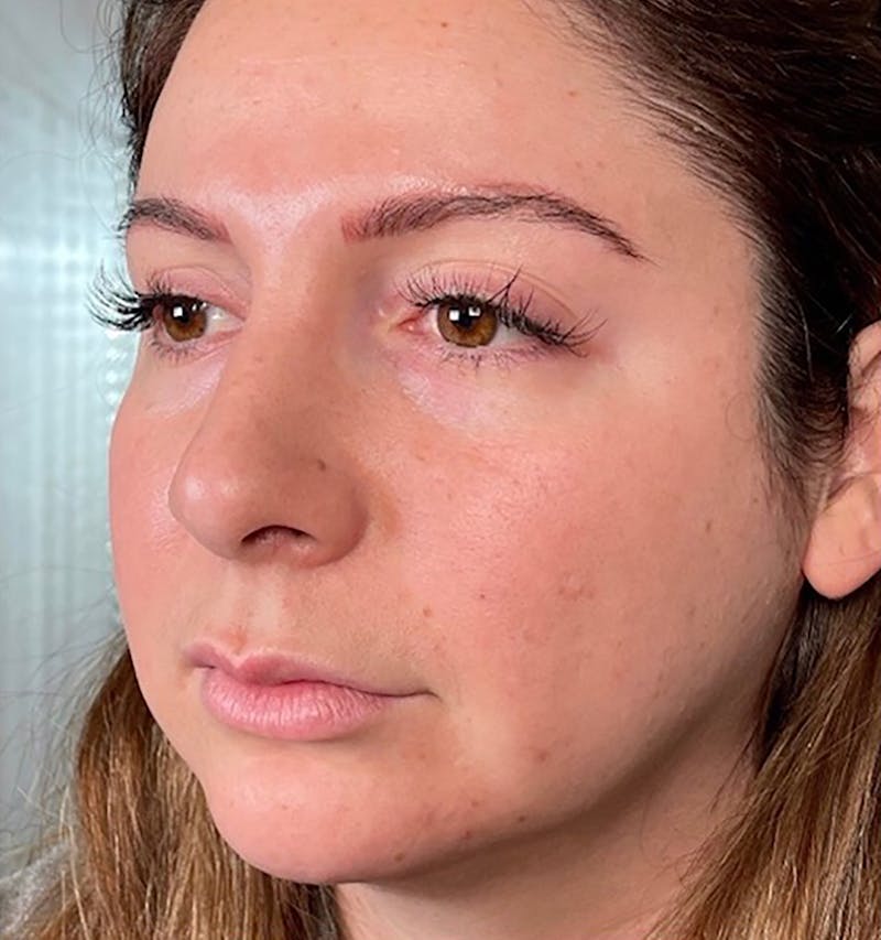 Dermal Fillers Before & After Gallery - Patient 66604041 - Image 1