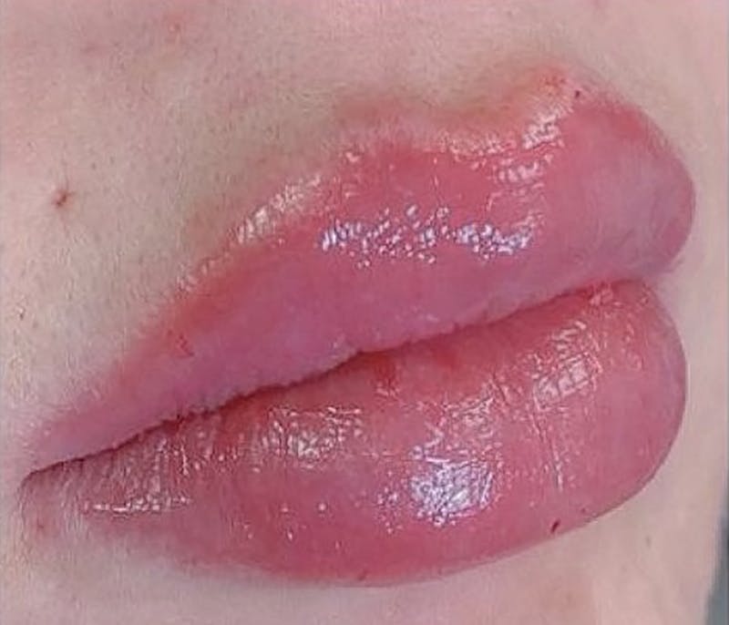 Dermal Fillers Before & After Gallery - Patient 66604042 - Image 2