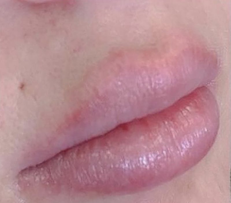 Dermal Fillers Before & After Gallery - Patient 66604042 - Image 1