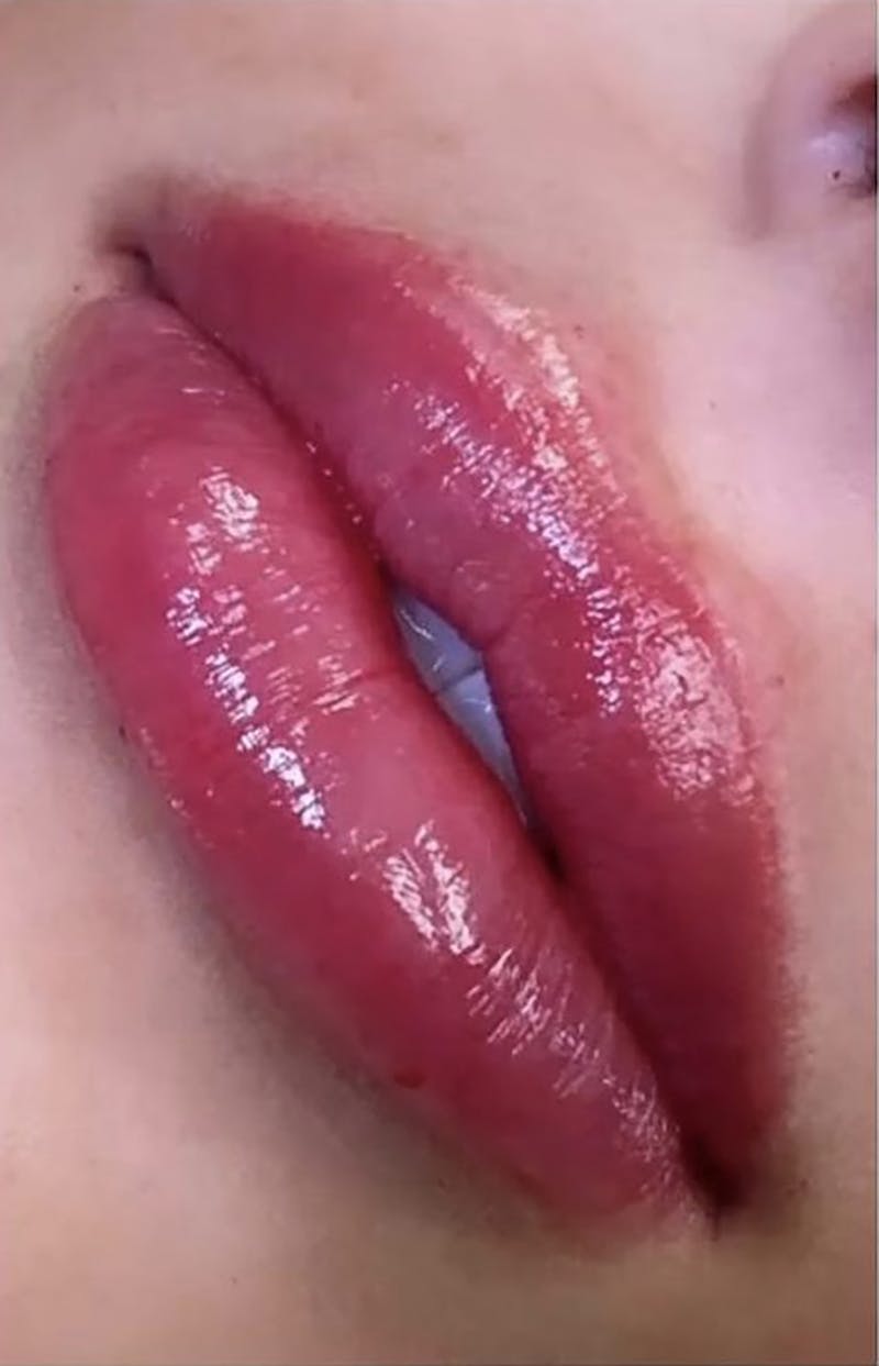 Dermal Fillers Before & After Gallery - Patient 66604043 - Image 2