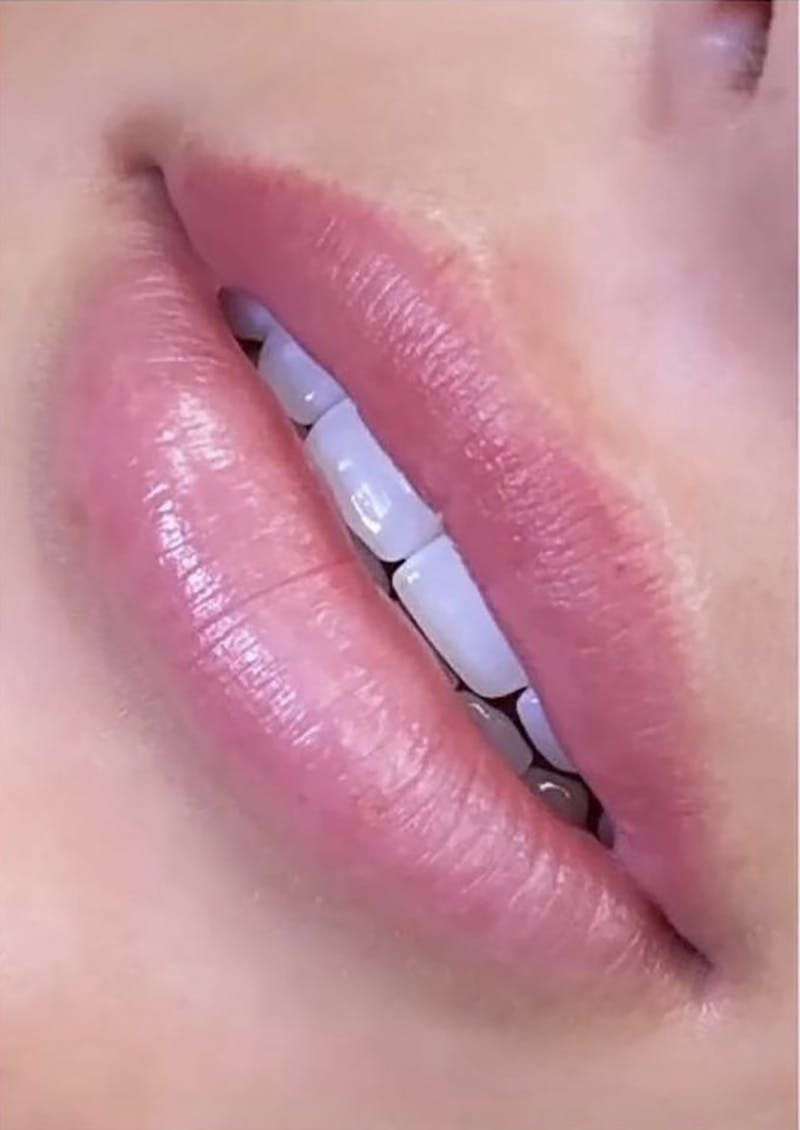 Dermal Fillers Before & After Gallery - Patient 66604043 - Image 1