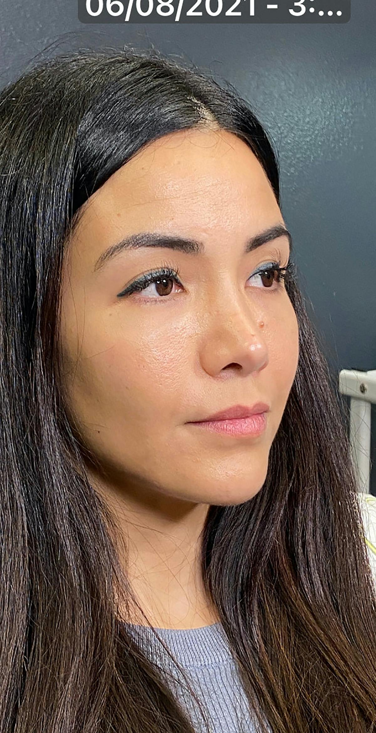 Dermal Fillers in San Antonio Before & After Photos